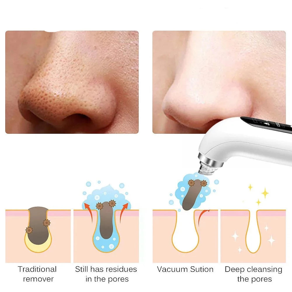 Electric Pimple Black Head Removal